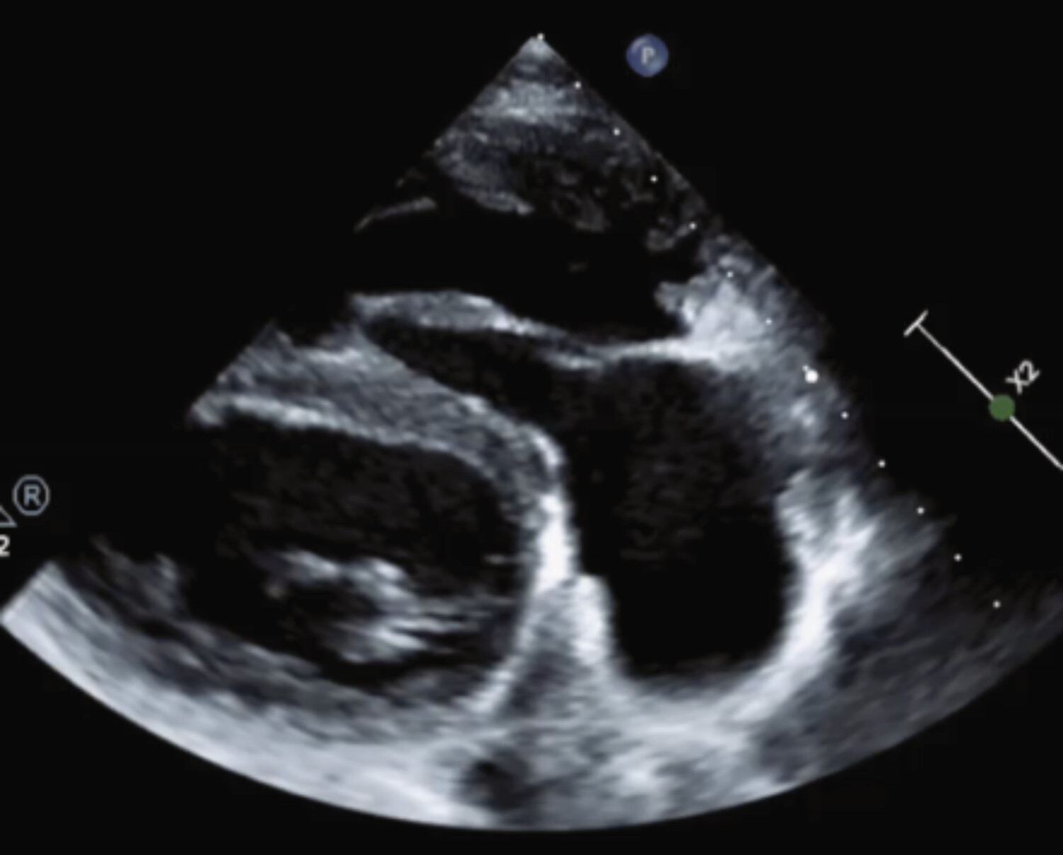 Intérêt de l’imagerie multimodale dans la prise en charge des cardiopathies congénitales  - Figure 7