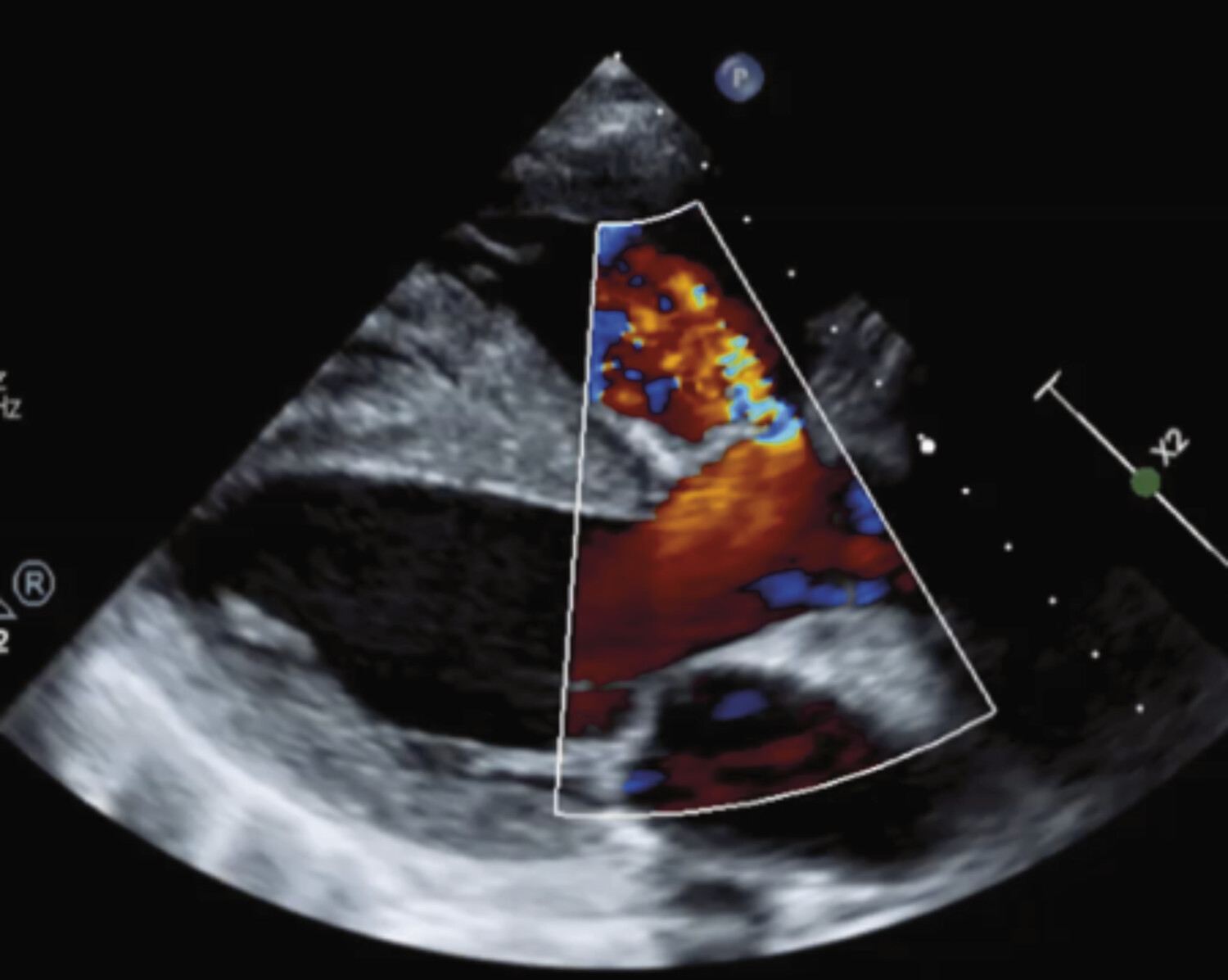 Intérêt de l’imagerie multimodale dans la prise en charge des cardiopathies congénitales  - Figure 2