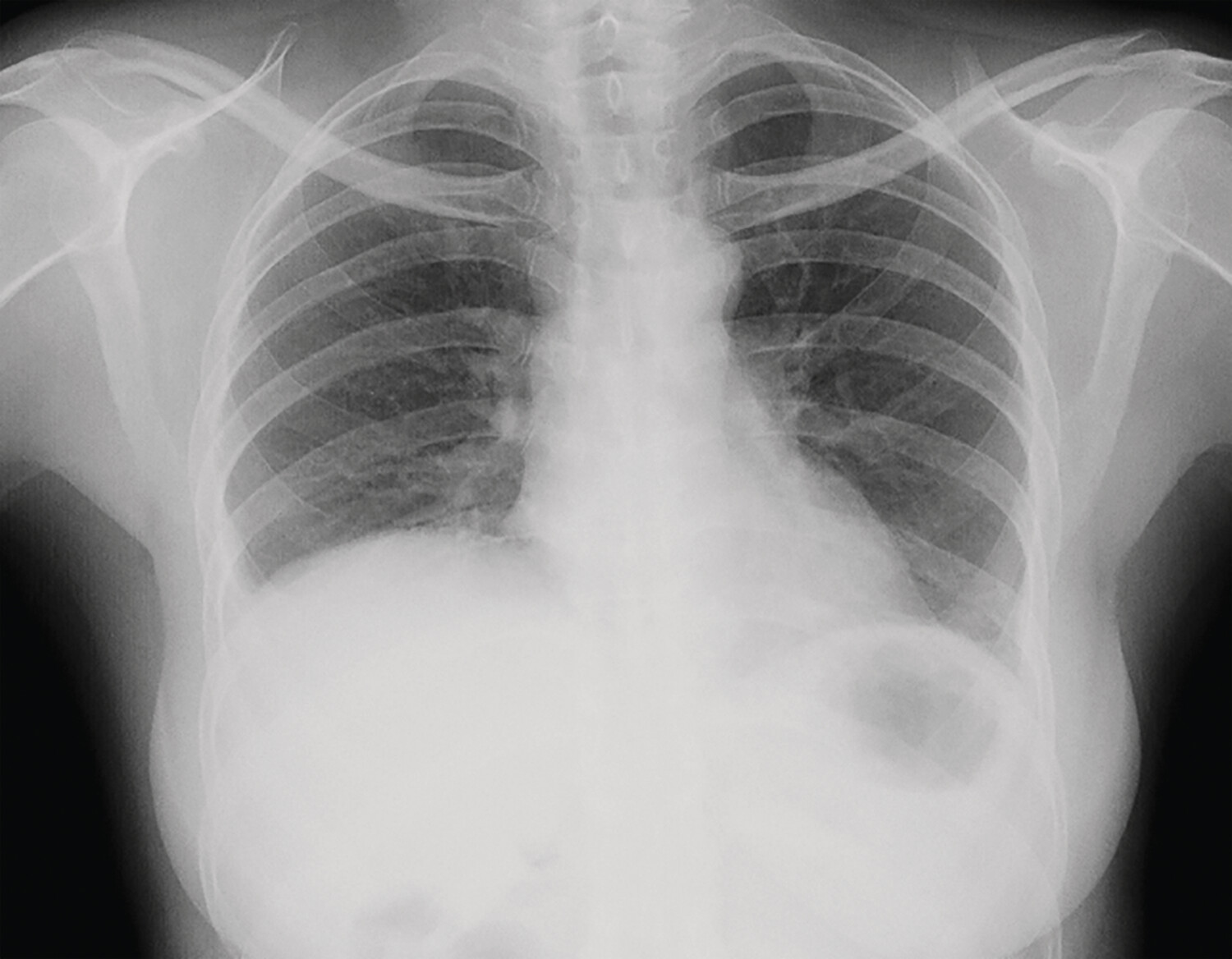 Lupus érythémateux systémique et poumon - Figure 3