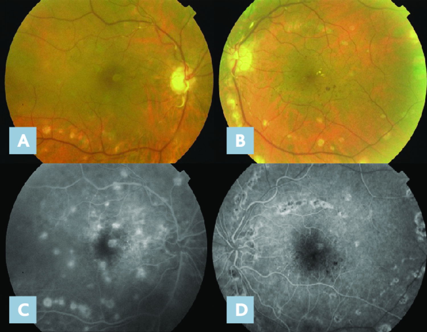 Atteinte oculaire et infection au virus West Nile - Figure 1
