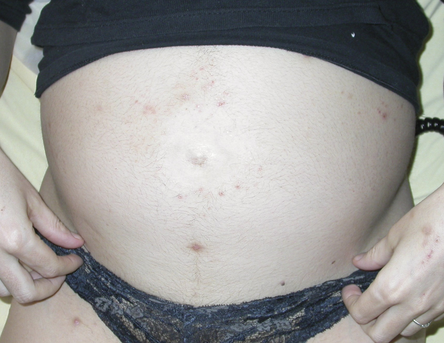 Principales manifestations cutanées au cours de la grossesse - Figure 12