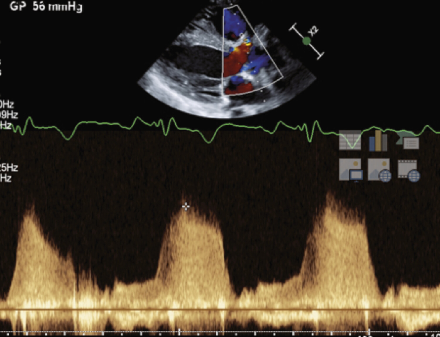 Intérêt de l’imagerie multimodale dans la prise en charge des cardiopathies congénitales  - Figure 3