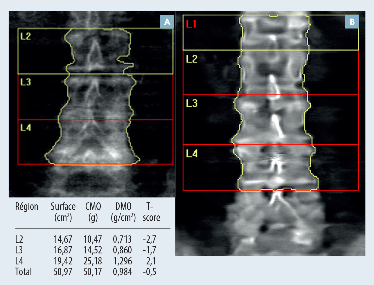 Densitométrie osseuse et VFA - Figure 6