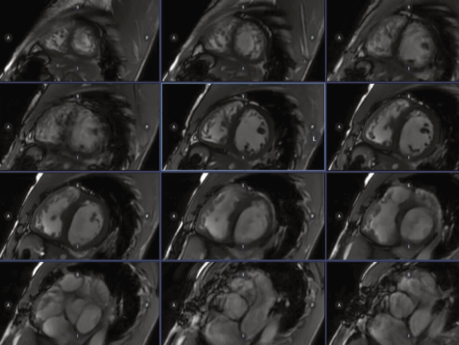 Intérêt de l’imagerie multimodale dans la prise en charge des cardiopathies congénitales  - Figure 13