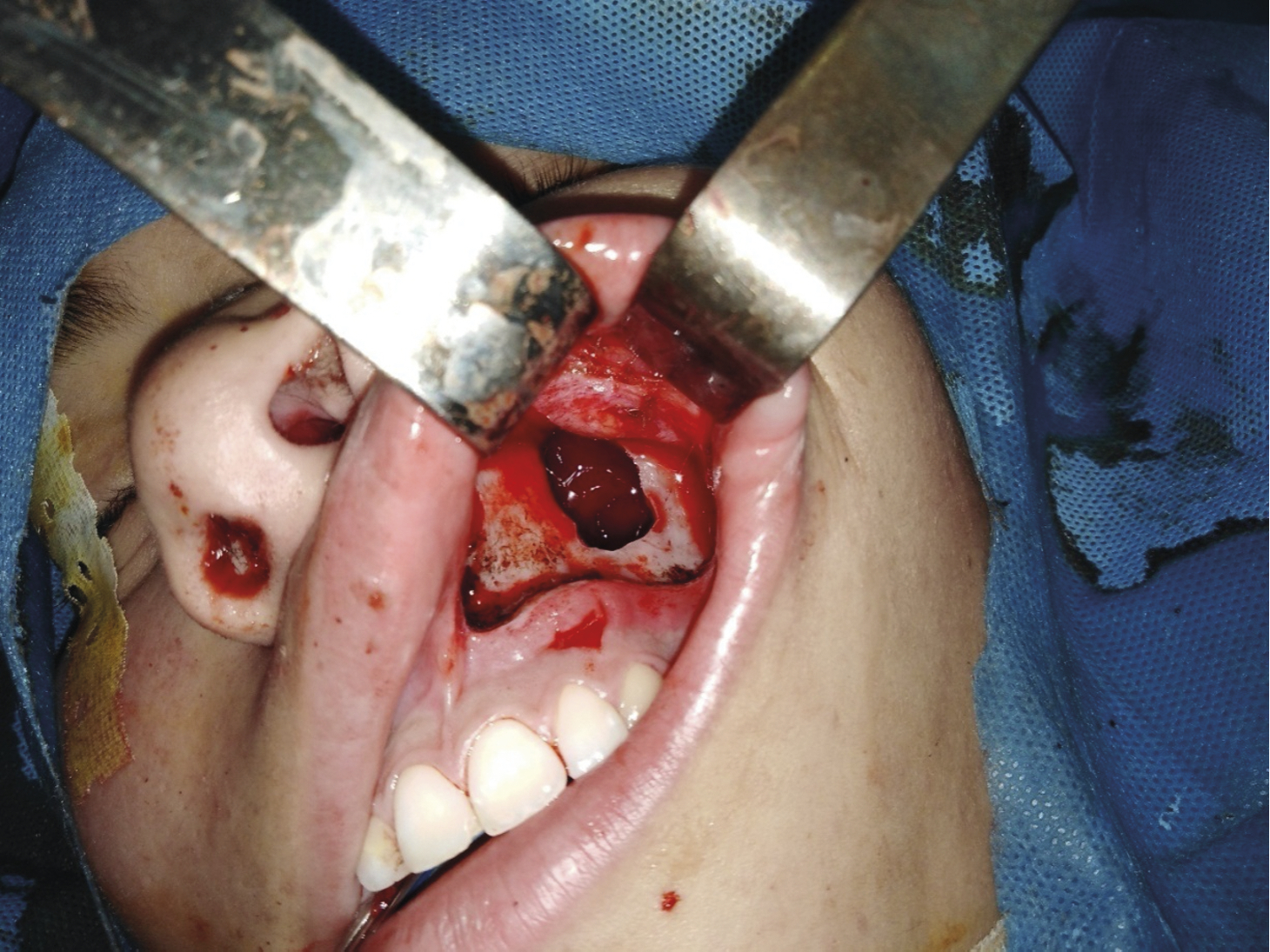Sinusite maxillaire secondaire à une molaire ectopique - Figure 3