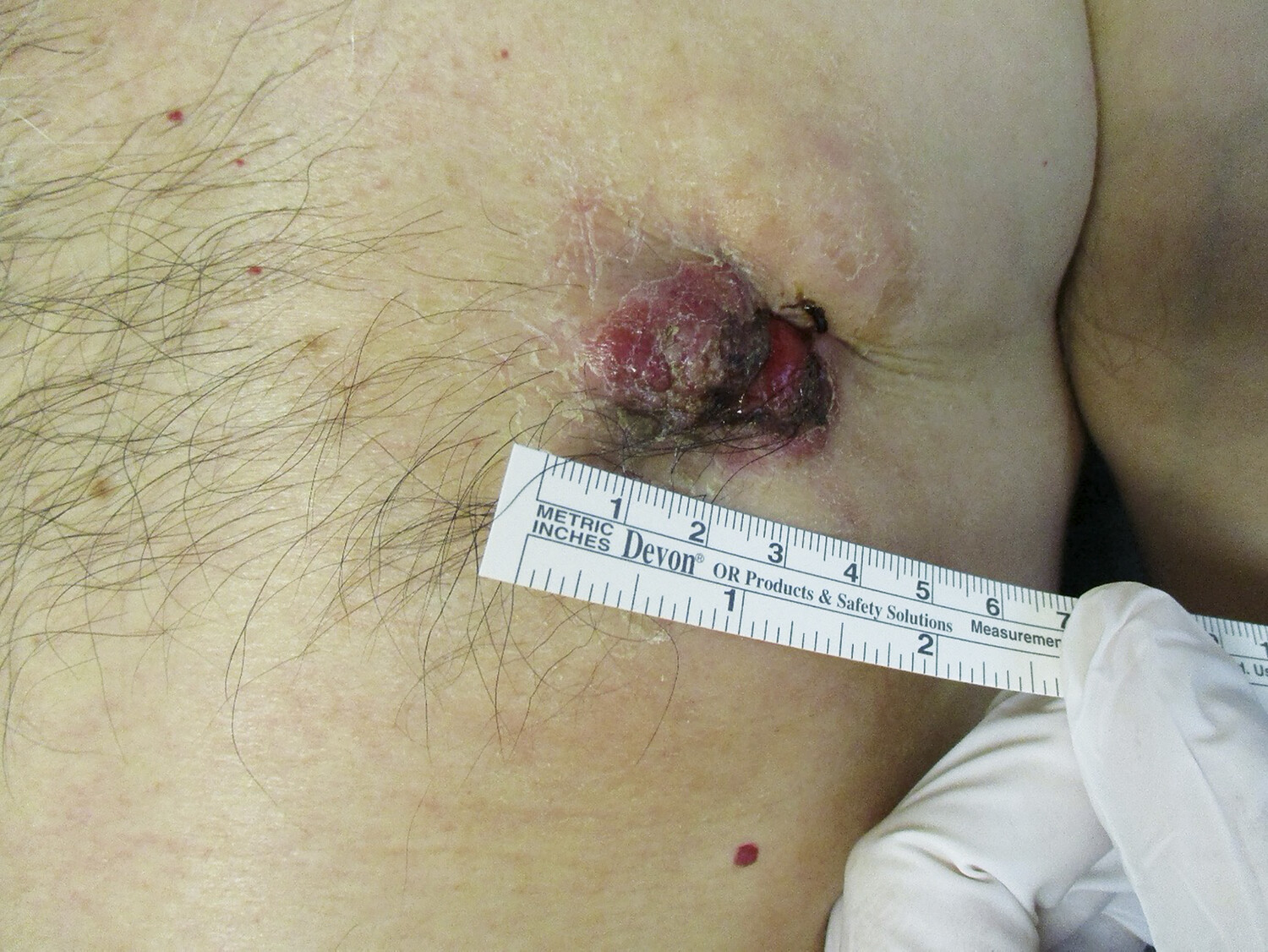 Cancer du sein chez l’homme - Figure