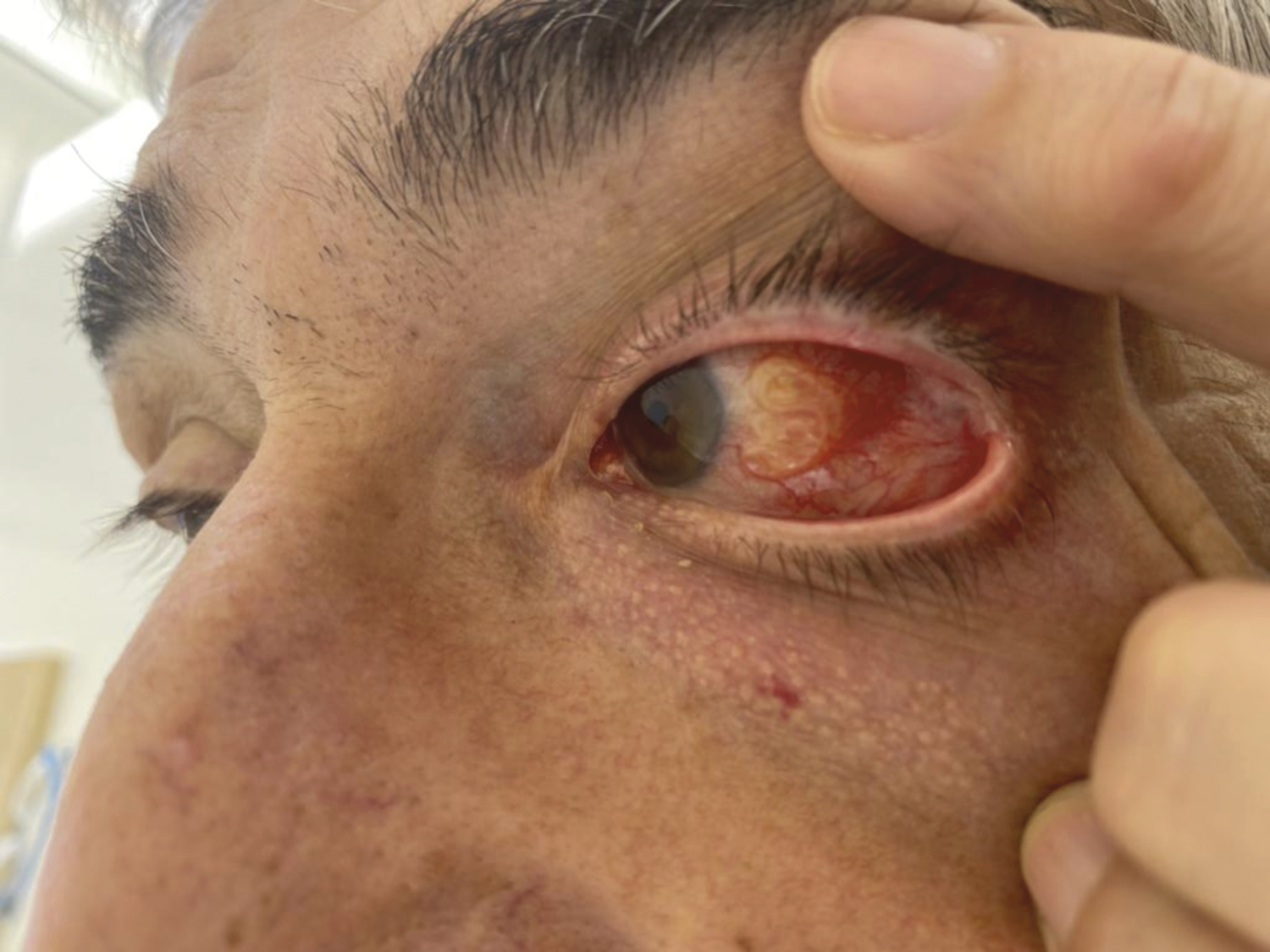Nouveau cas de dirofilariose oculaire en Corse - Figure