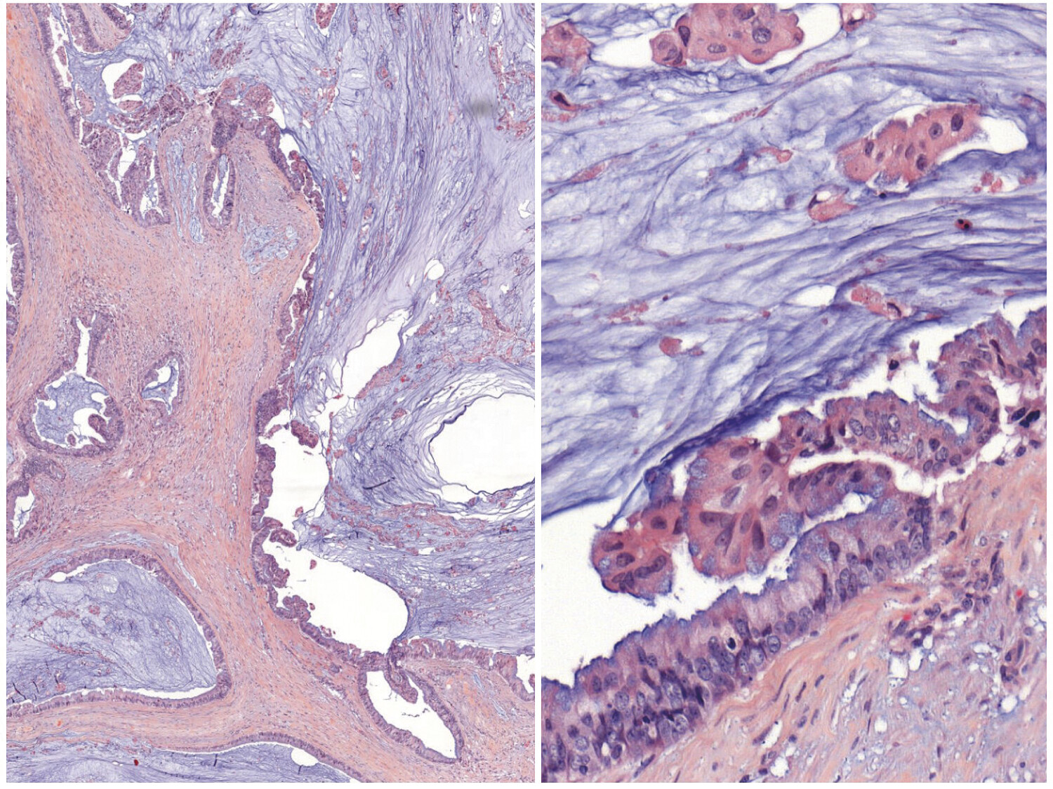 Cystadénocarcinome mucineux mammaire : le retour d’une tumeur rare du sein - Figure 1