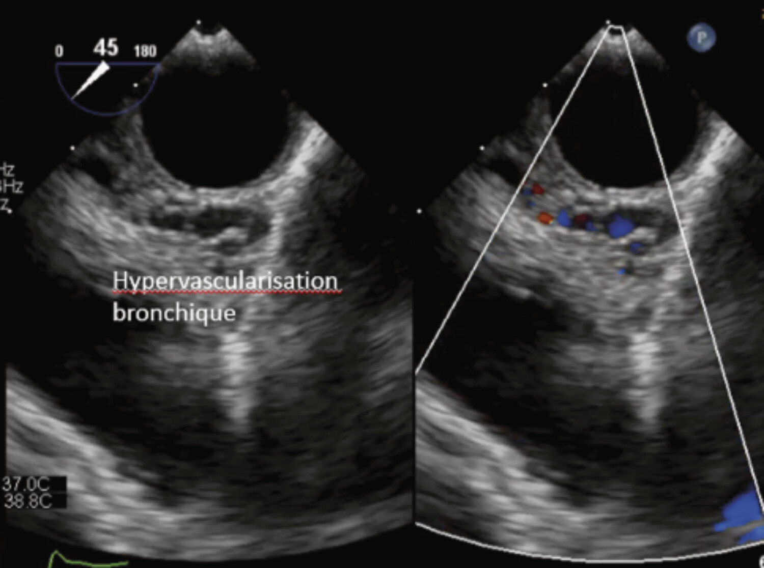 Intérêt de l’imagerie multimodale dans la prise en charge des cardiopathies congénitales  - Figure 9