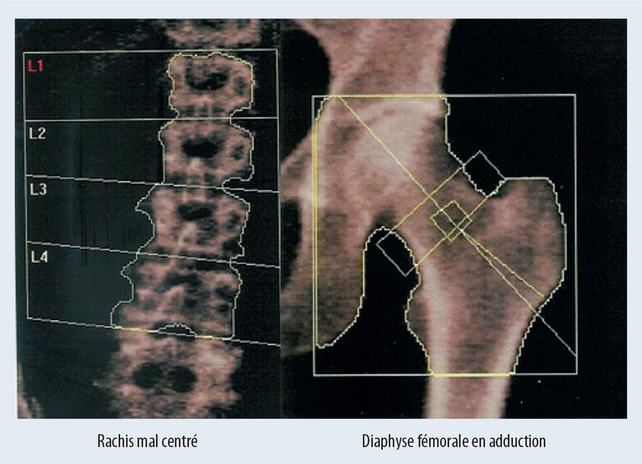 Densitométrie osseuse et VFA - Figure 4