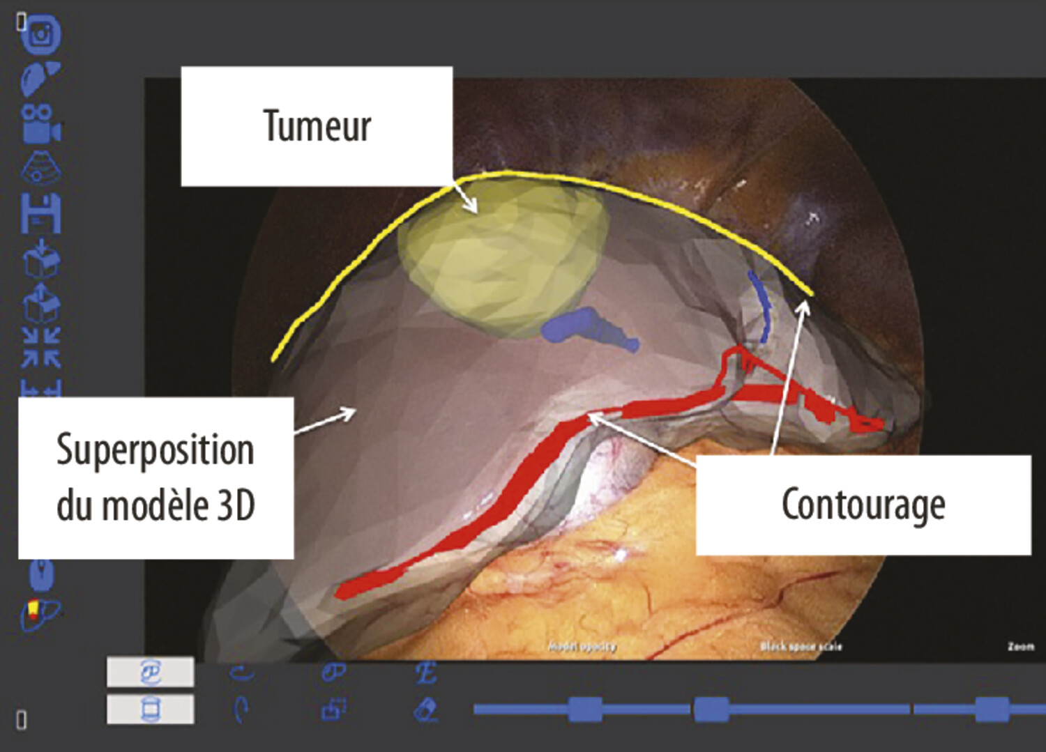 Chirurgie des tumeurs du foie en réalité augmentée - Figure 2