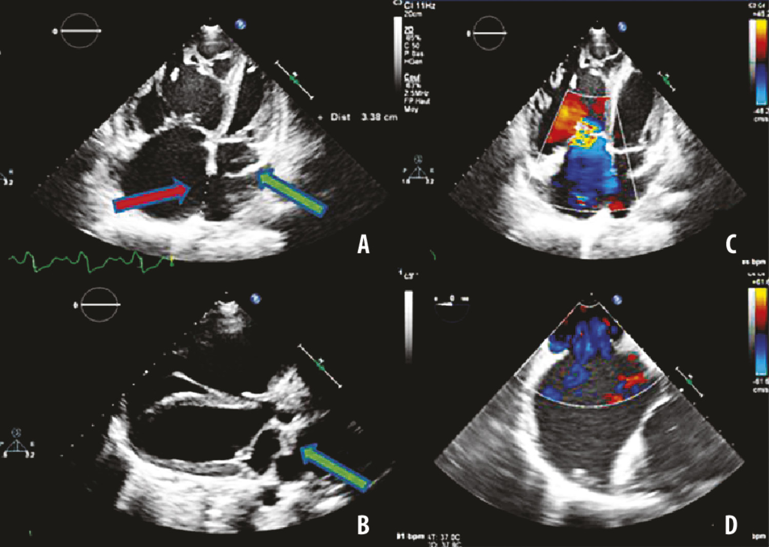Cœur triatrial et syndrome coronarien aigu - Figure 2