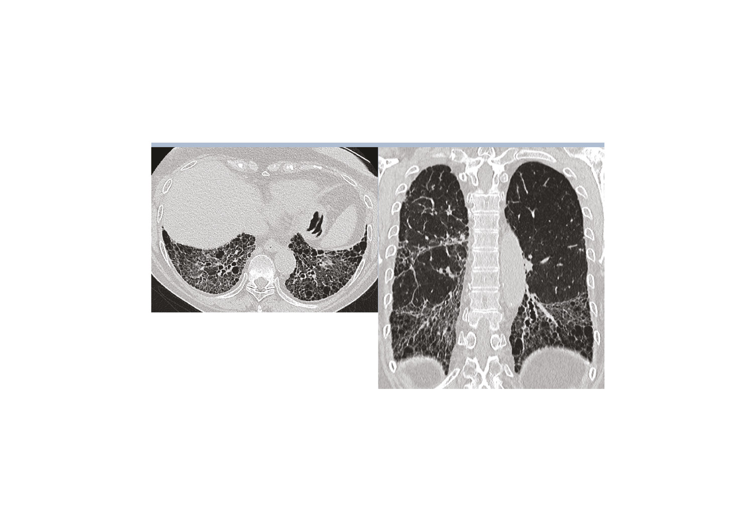 Imagerie tomodensitométrique des pneumopathies interstitielles diffuses idiopathiques : comment s’orienter ?  - Figure 1