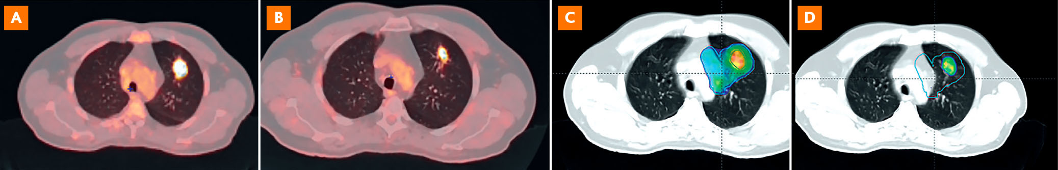 Apport de l’imagerie TEP dans la radiothérapie des cancers du poumon - Figure 2