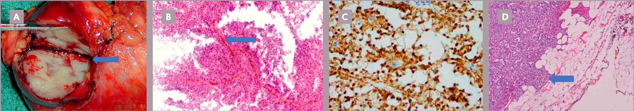 Tumeur pancréatique rare de la jeune fille : la tumeur pseudopapillaire et solide du pancréas ou tumeur de Frantz - Figure 5