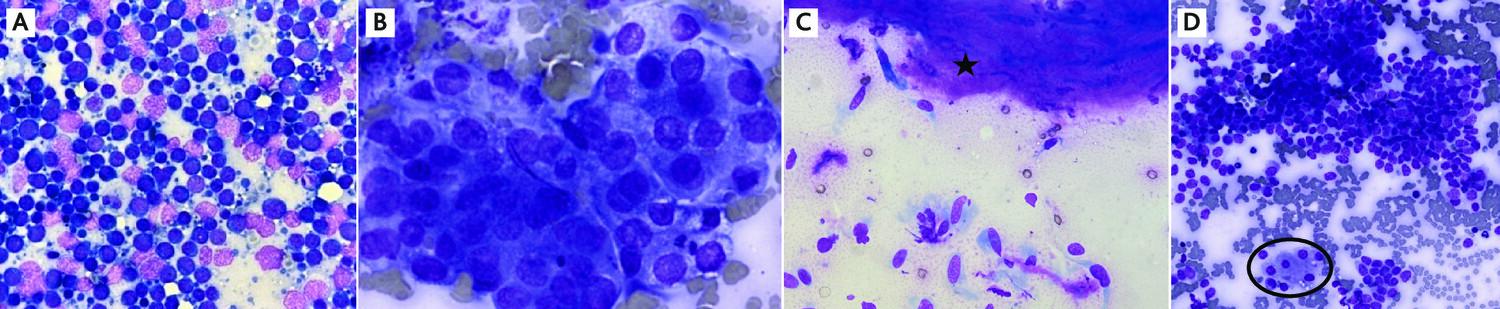 L’identification tumorale : ­cytologie, cytométrie en flux, histologie et ­immunohistochimie - Figure 2