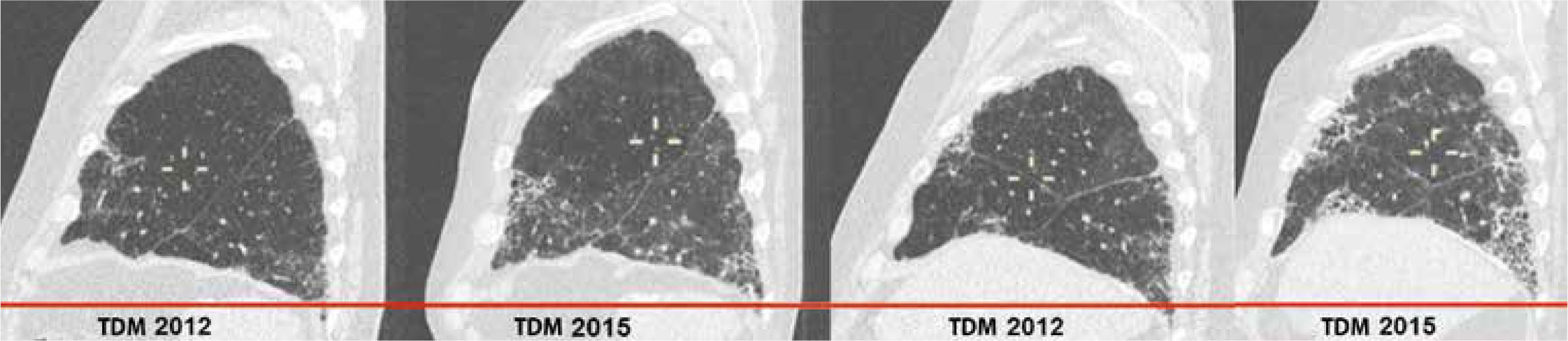 Asbestose ou fibrose pulmonaire idiopathique ? - Figure 4