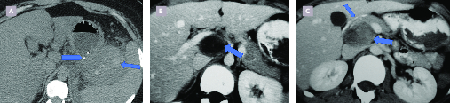 Tumeur pancréatique rare de la jeune fille : la tumeur pseudopapillaire et solide du pancréas ou tumeur de Frantz - Figure 2