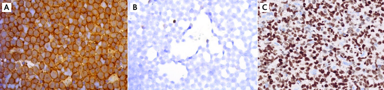 L’identification tumorale : ­cytologie, cytométrie en flux, histologie et ­immunohistochimie - Figure 4