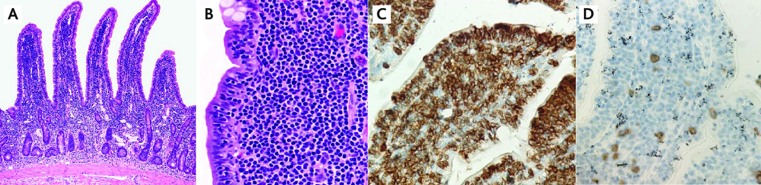 L’identification tumorale : ­cytologie, cytométrie en flux, histologie et ­immunohistochimie - Figure 5