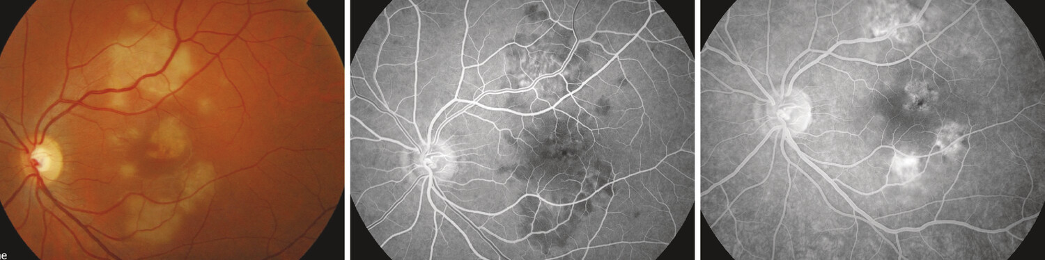 Intérêt de l’angiographie à la fluorescéine dans le diagnostic de taches blanches du fond d’œil - Figure 2
