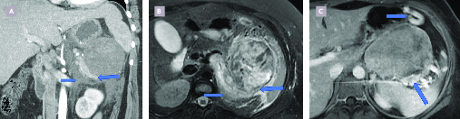 Tumeur pancréatique rare de la jeune fille : la tumeur pseudopapillaire et solide du pancréas ou tumeur de Frantz - Figure 4