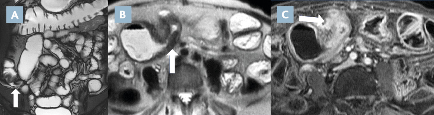 Imagerie en coupes actuelle de la maladie de Crohn (2e partie)  - Figure 2