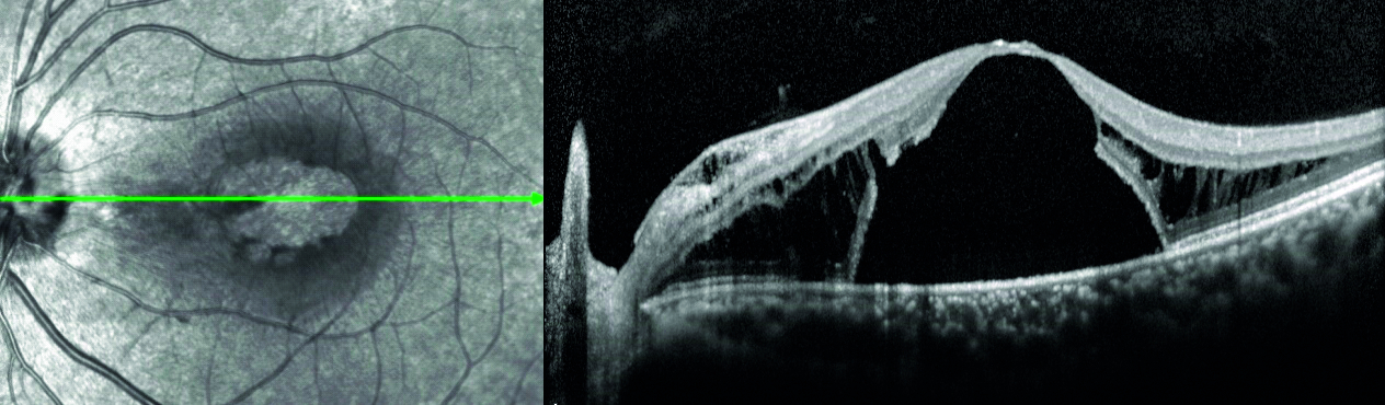 Décollement séreux rétinien et trou maculaire externe compliquant une fossette colobomateuse de la papille - Figure 3