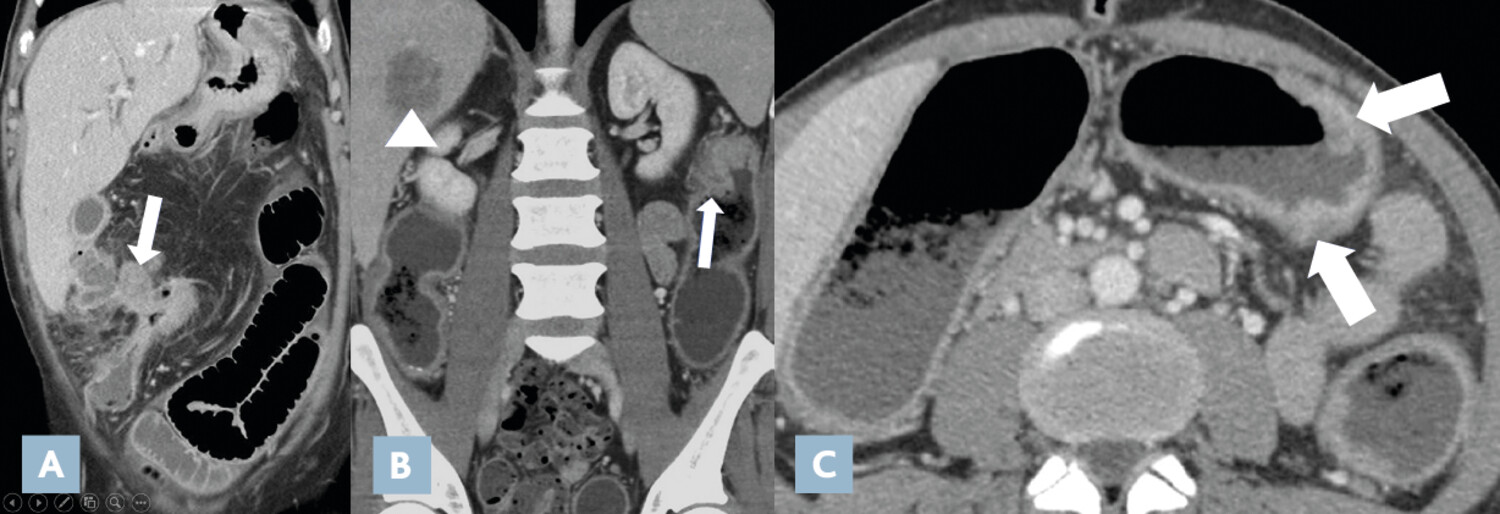 Imagerie en coupes actuelle de la maladie de Crohn (2e partie)  - Figure 7