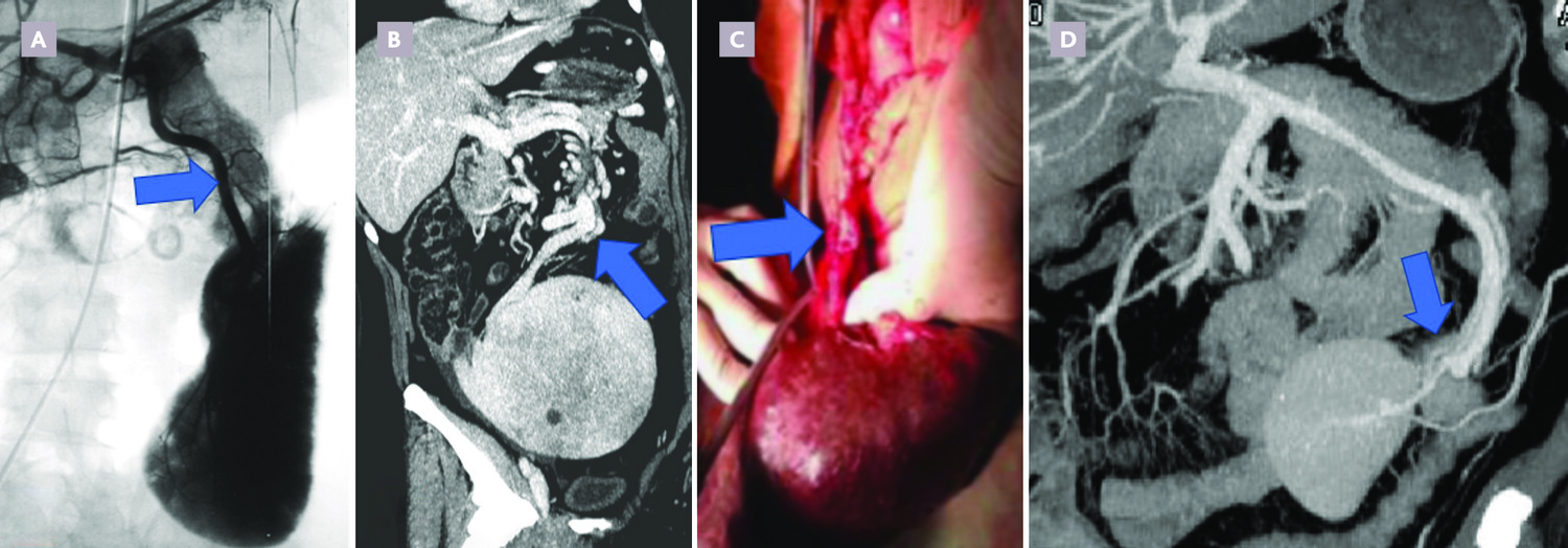 Une cause rare d’abdomen aigu : la rate baladeuse ou wandering spleen - Figure 2