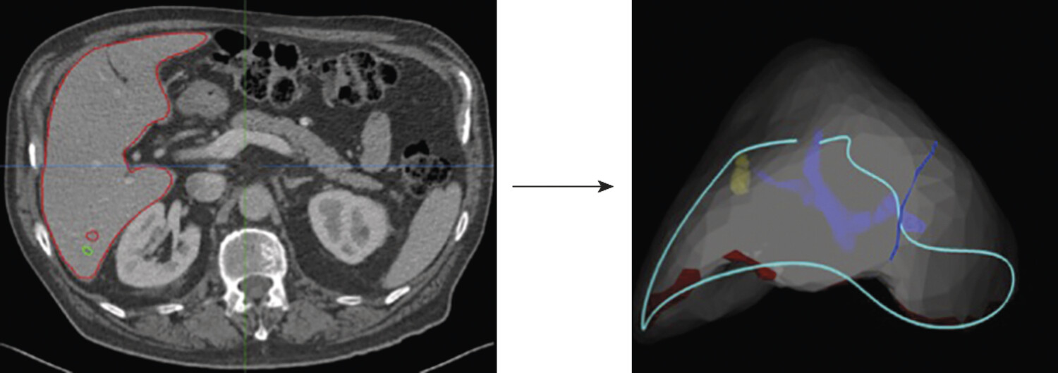 Chirurgie des tumeurs du foie en réalité augmentée - Figure 1
