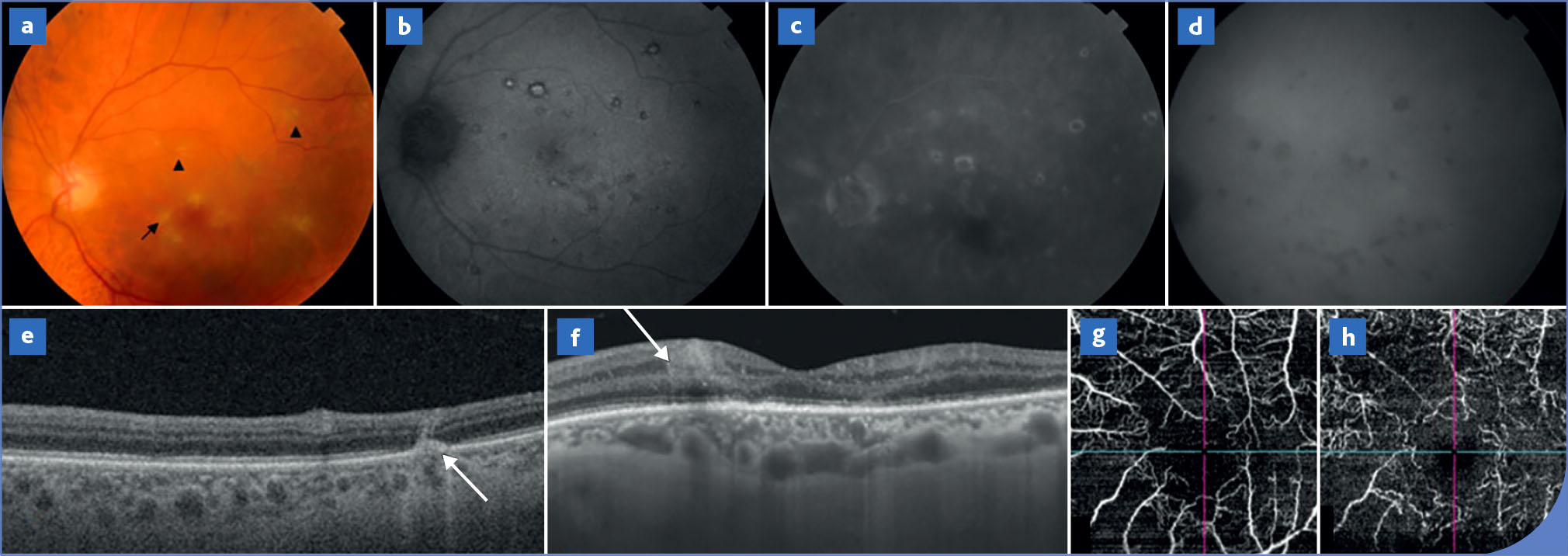 Atteinte oculaire et infection au virus West Nile - Figure 2