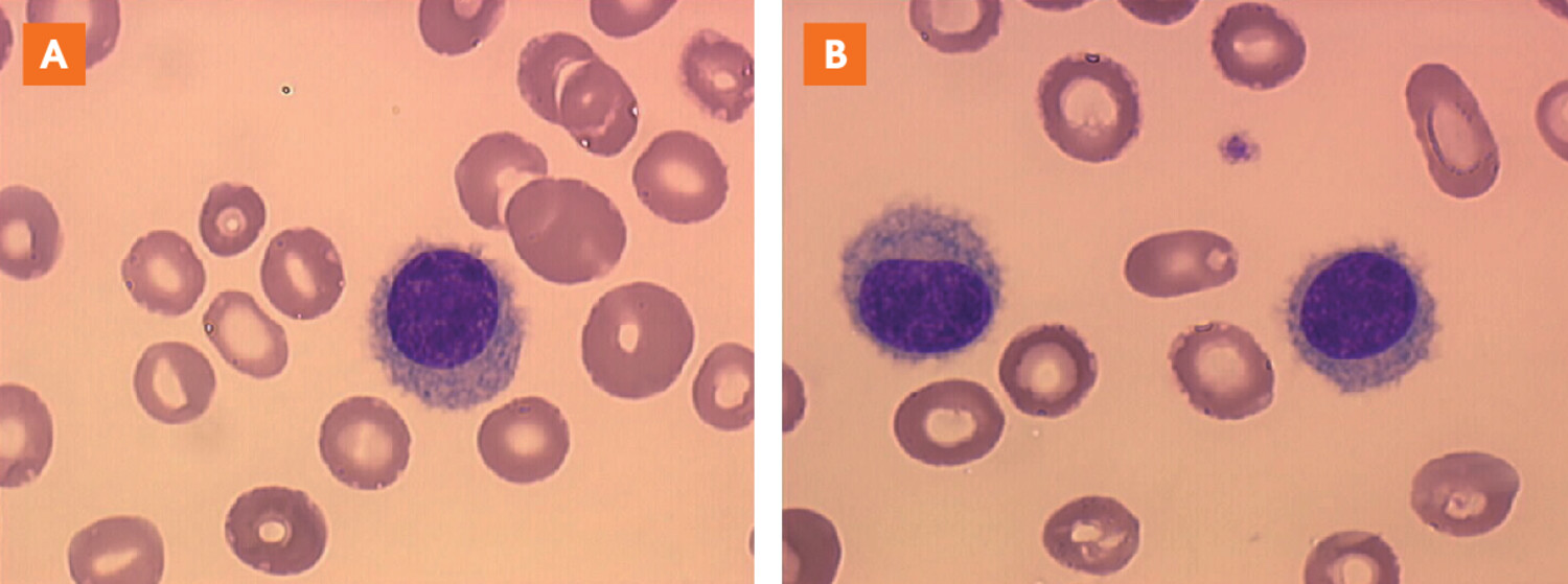 Leucémie à tricholeucocytes - Figure 1