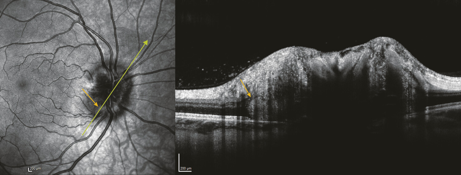 Drusen de la tête du nerf optique et autres formations péripapillaires - Figure 5