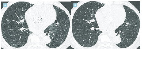 Critères de qualité du scanner thoracique réalisé pour une pneumopathie infiltrante diffuse - Figure 5