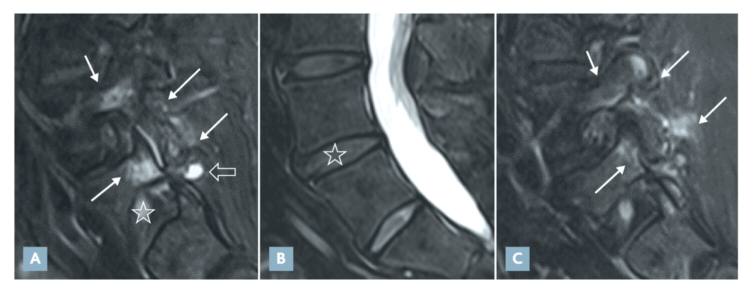 Imagerie diagnostique et interventionnelle dans la lombalgie mécanique - Figure 2