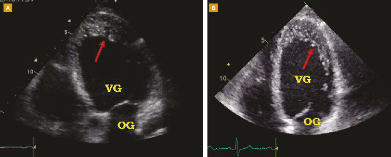 Actualités sur la non-compaction isoléedu ventricule gauche - Figure 2
