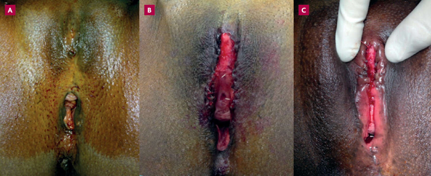Les mutilations génitales féminines - Figure 6
