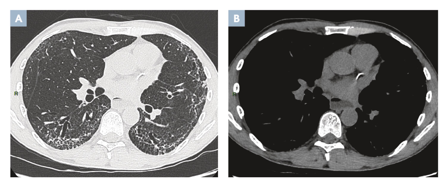 Traitement de la fibrose pulmonaire associée à la sclérodermie - Figure 1