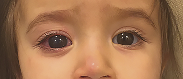 Pièges diagnostiques à éviter dans la myopie de l’enfant - Figure 1