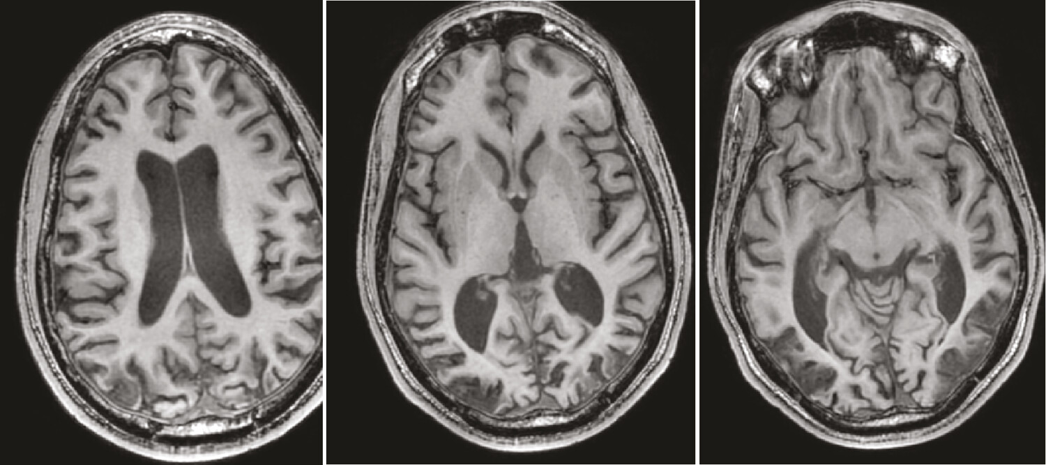 Cécité cérébrale : évolution et prise en charge en médecine physique et de réadaptation ; exemple d’un cas clinique - Figure