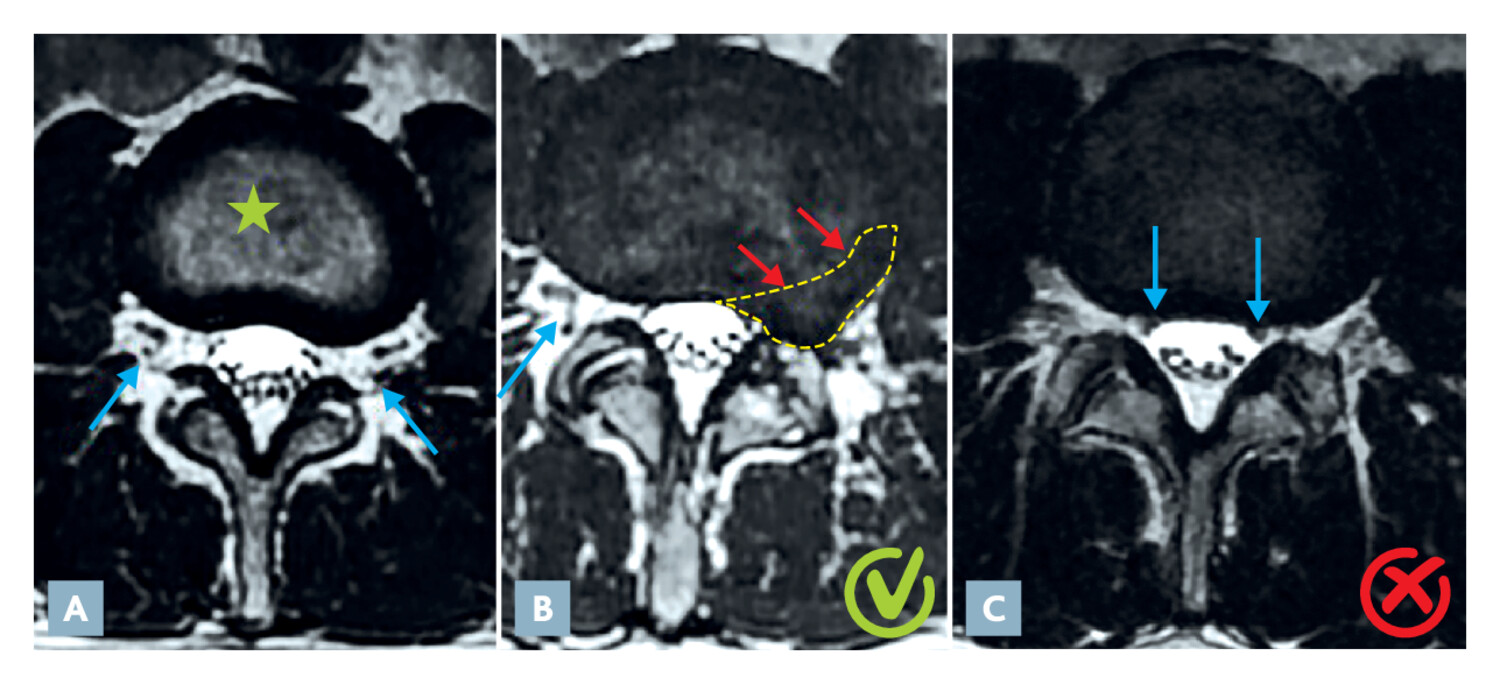 Imagerie diagnostique et interventionnelle dans la lombalgie mécanique - Figure 4