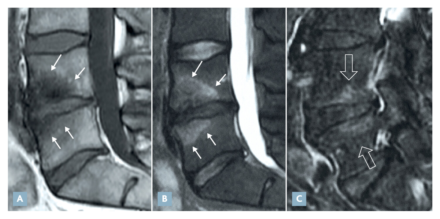 Imagerie diagnostique et interventionnelle dans la lombalgie mécanique - Figure 1