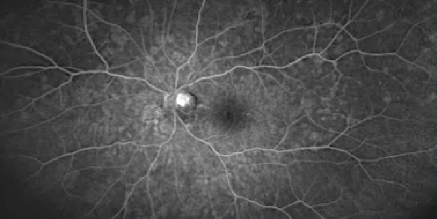 Intérêt de l’angiographie à la fluorescéine dans le diagnostic de taches blanches du fond d’œil - Figure 1