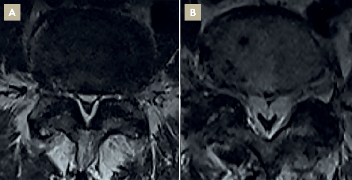 Une lombosciatique bilatérale révélatrice d’une lipomatose vertébrale épidurale idiopathique chez un sujet obèse - Figure 2