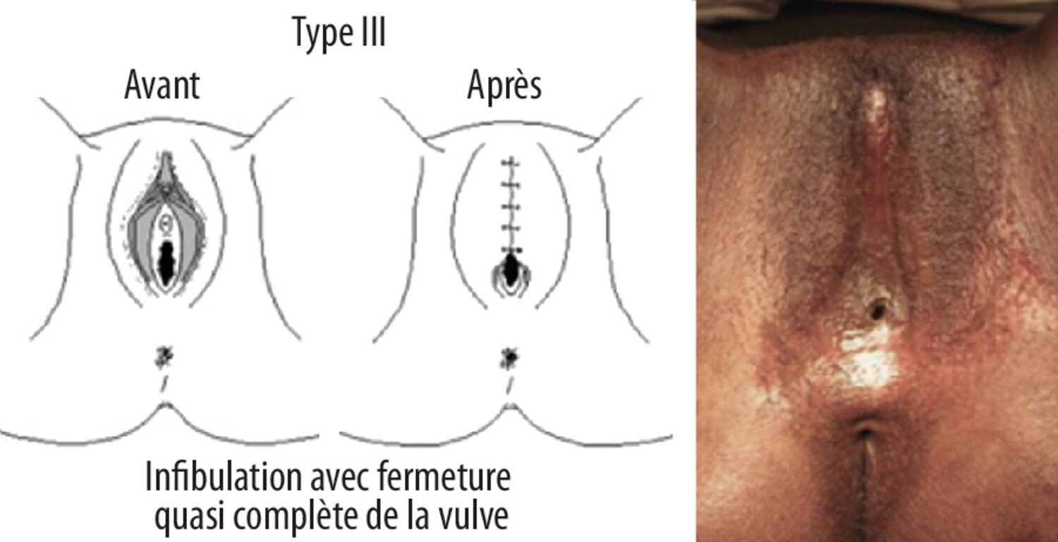 Les mutilations génitales féminines - Figure 4