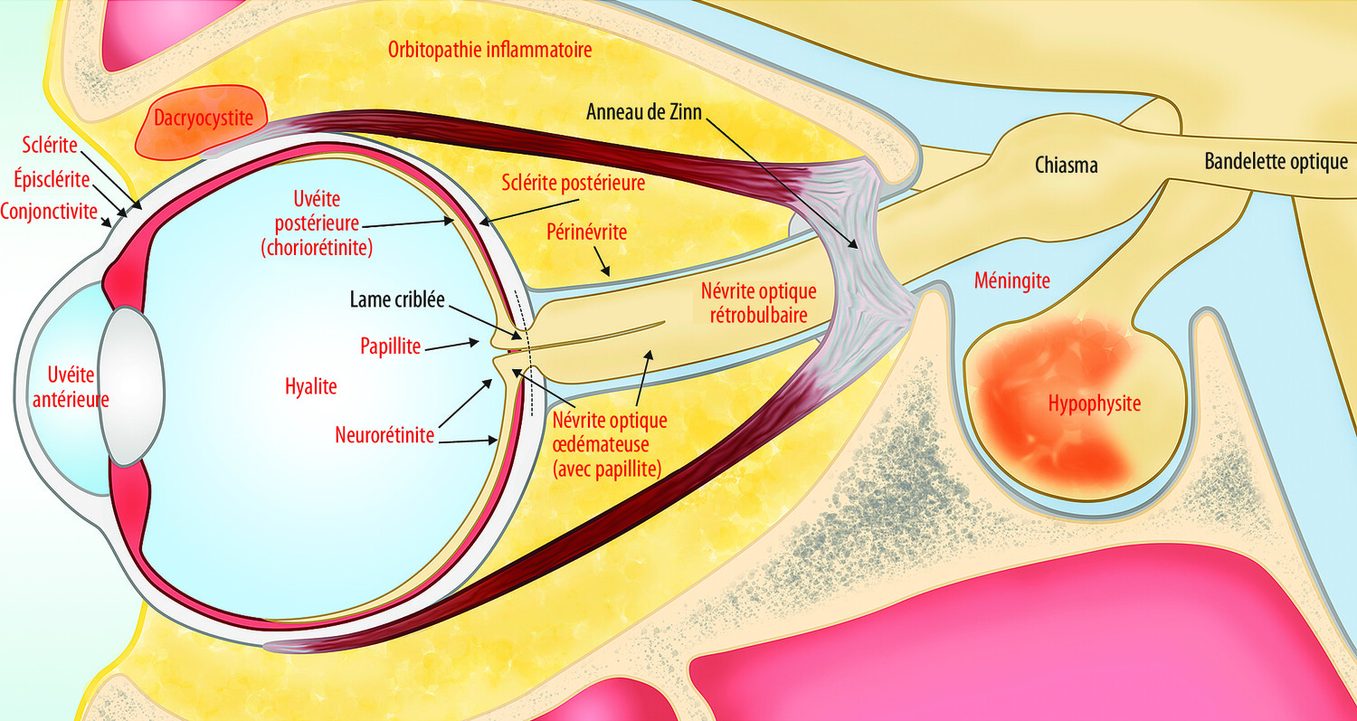 Diagnostic différentiel de névrite optique : le point de vue du neurologue - Figure