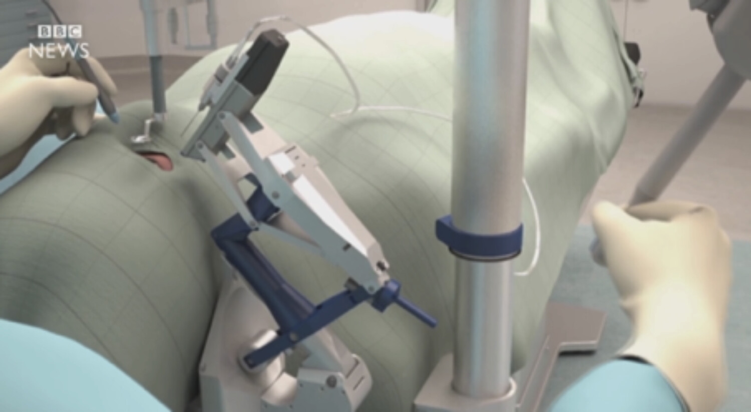 La robotique chirurgicale au service de la chirurgie du futur - Figure 3