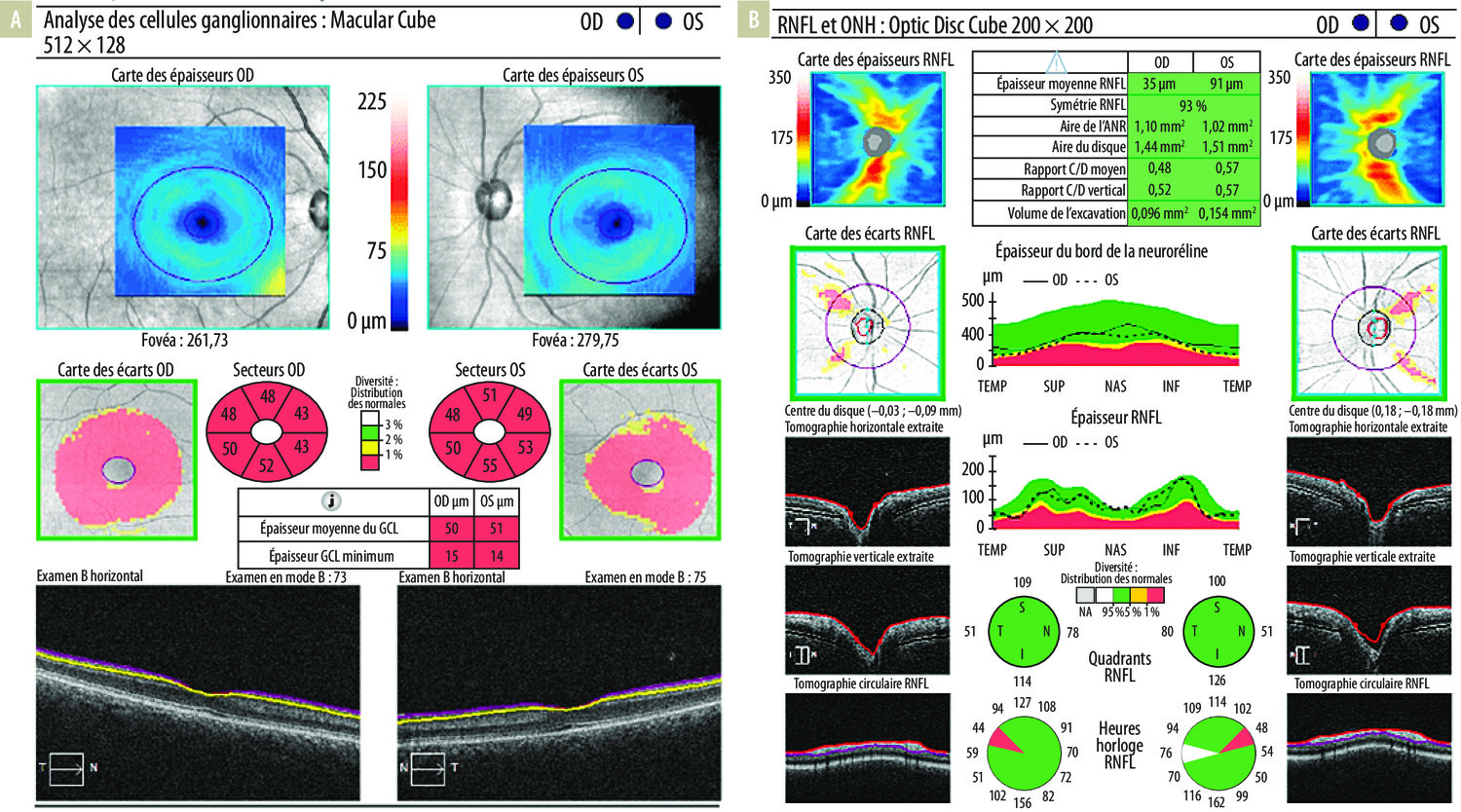 Baisse d’acuité visuelle indolore chez un jeune adulte : penser à la neuropathie optique héréditaire de Leber  - Figure 3