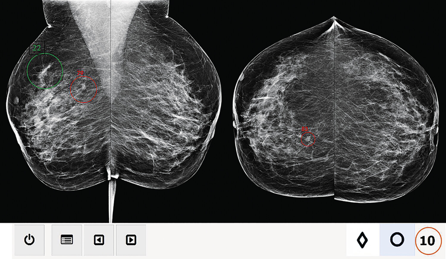 Intelligence artificielle en mammographie et dépistage du cancer du sein - Figure 3
